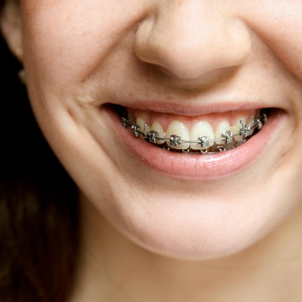 Dental Braces St. Albert